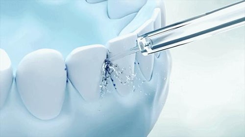 Lợi ích của dụng cụ xỉa nước cho người đeo niềng răng